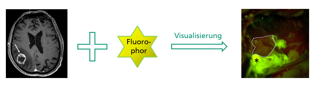 Anfärbung von Tumorgewebe mittels Fluorophor